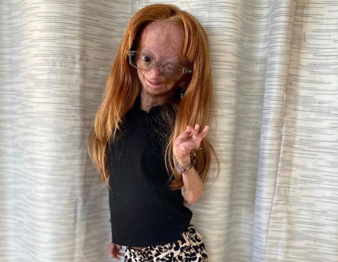 Adalia Rose