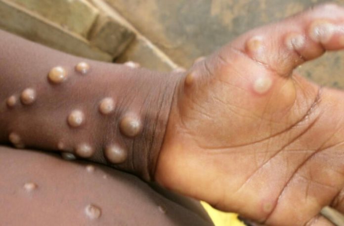 Monkeypox