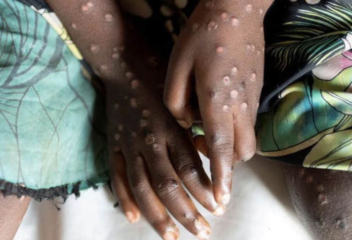 Monkey pox