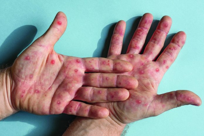 monkeypox
