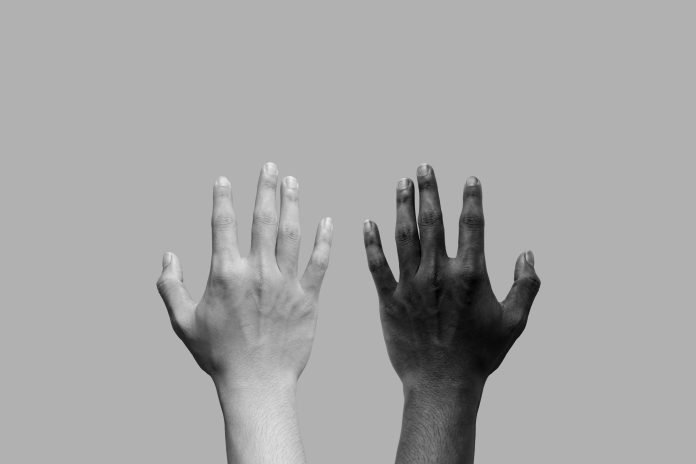 male with White and Black skin in stop racism concept , discrimi